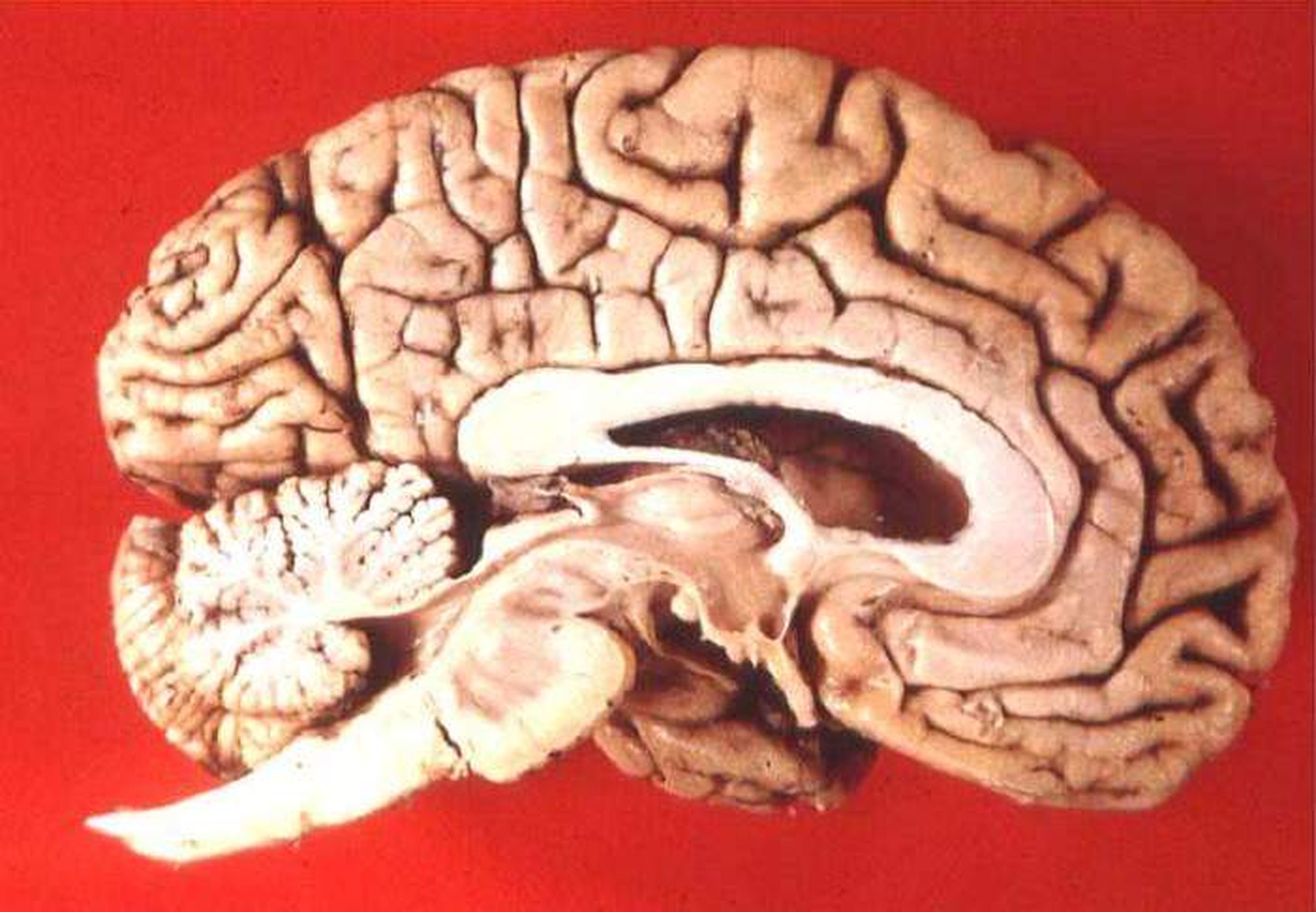 Vista lateral del cerebro
