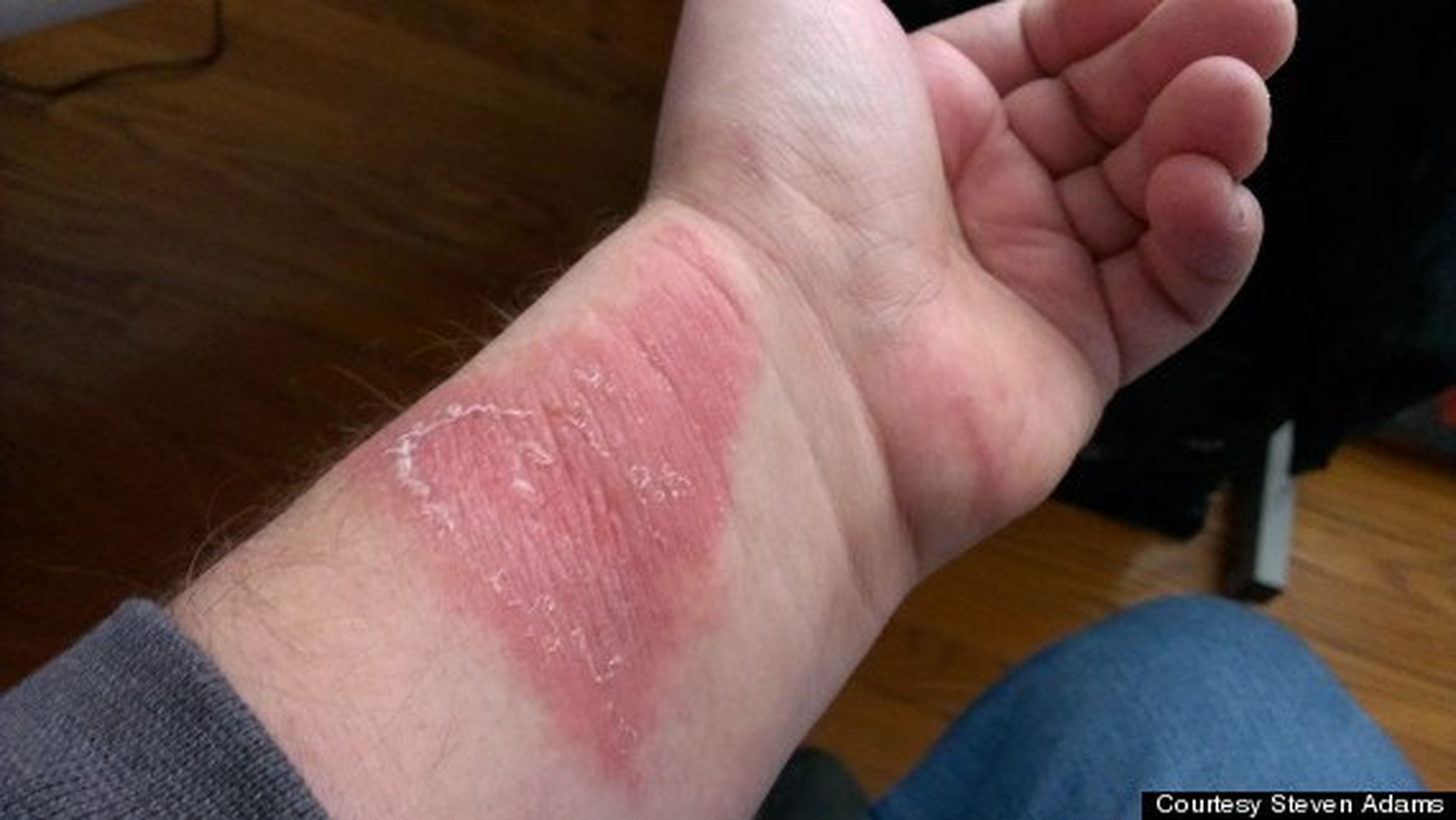 Steve Adams muestra la reacción alérgica tras usar Force un mes (foto: HuffingtonPost)