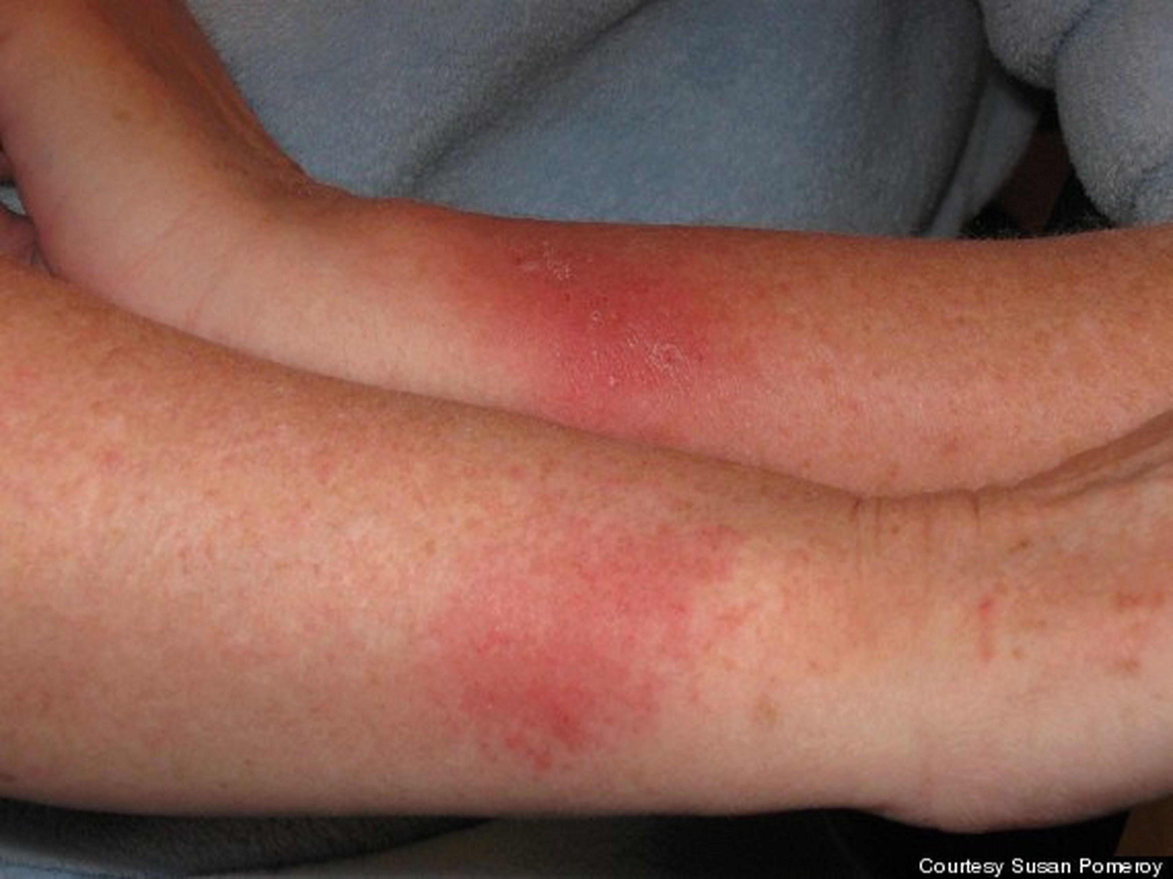 Susan Pomeroy también presentó dermatitis de contacto al usar el Force (Foto: HuffingtonPost)