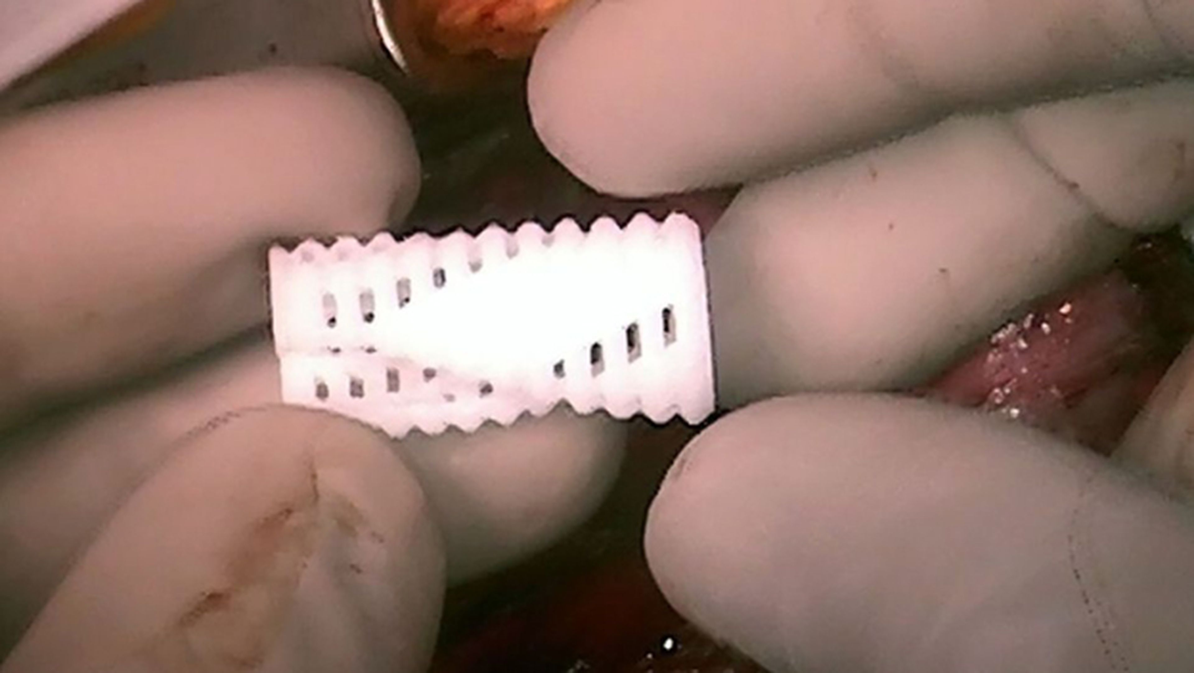 Un implante hecho en impresora 3D salva la vida a 3 bebés