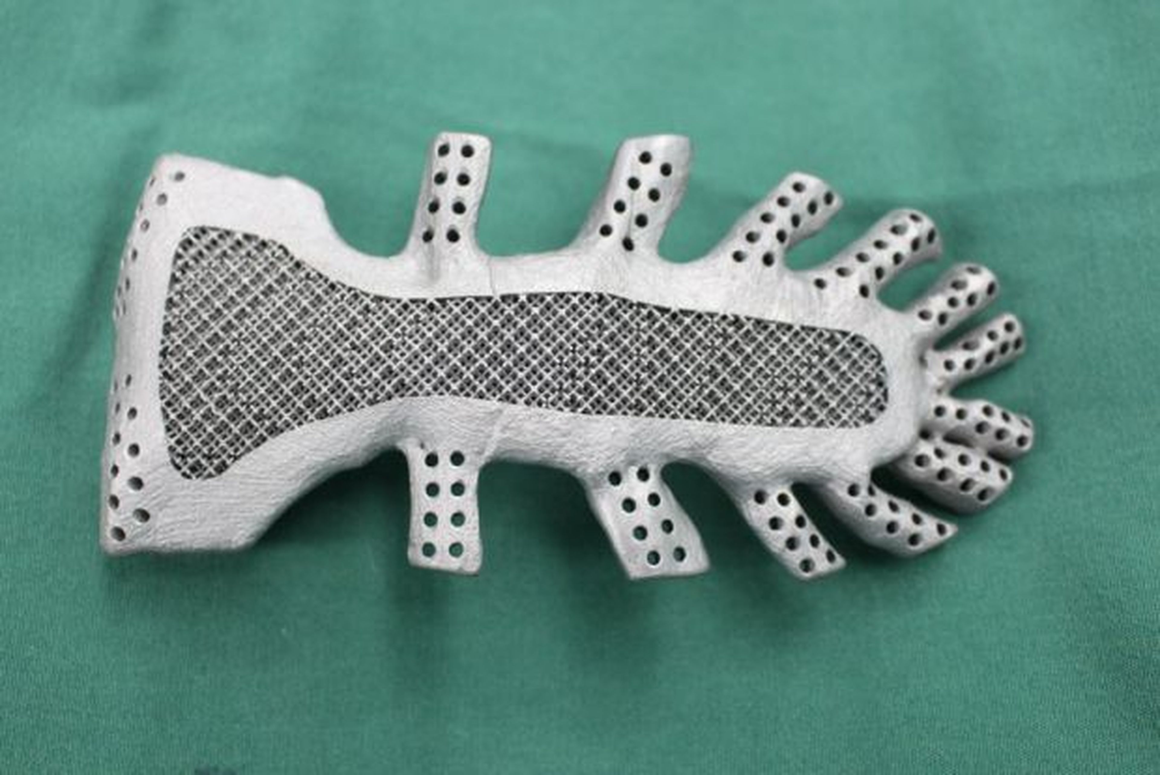 Primer implante de un esternón impreso en 3D