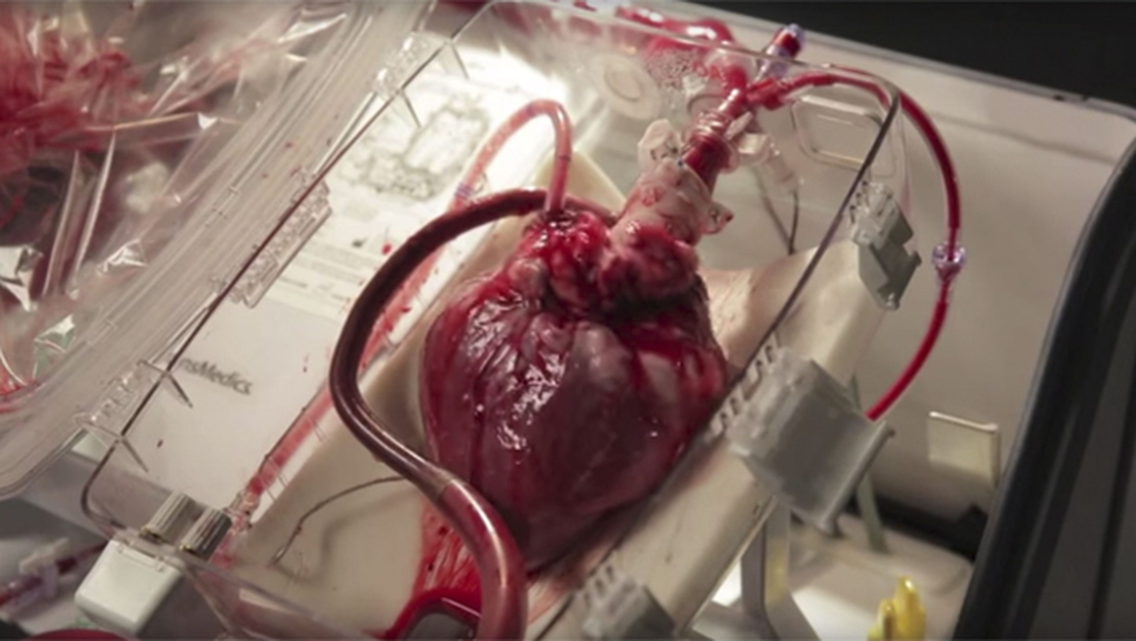 Un dispositivo puede revivir corazones después de la muerte