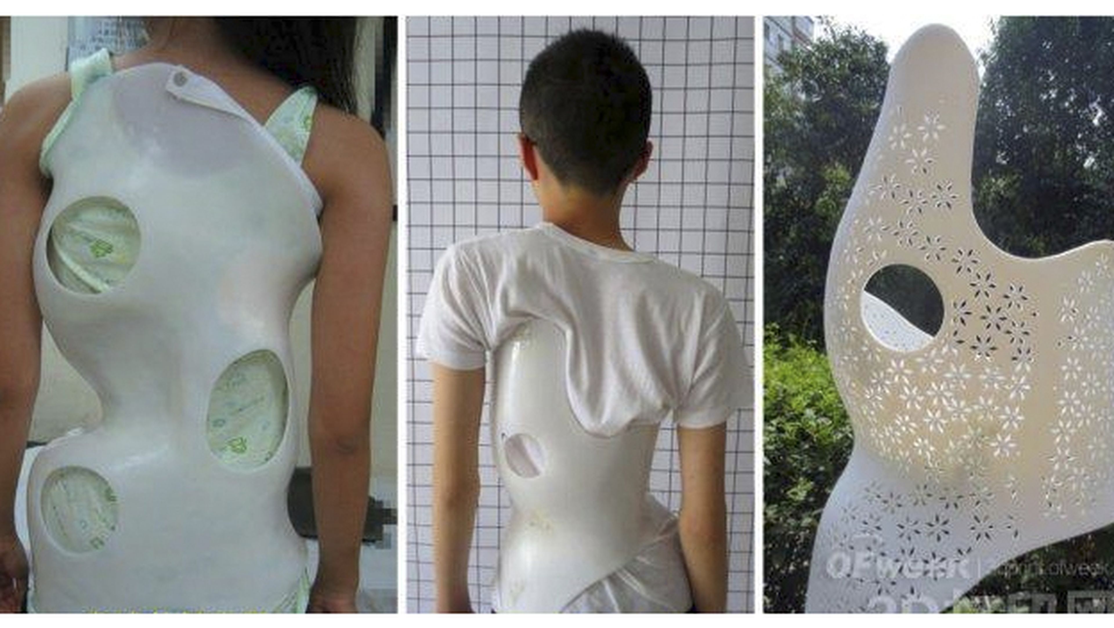 Prótesis impresas en 3D para tratar los problemas de espalda