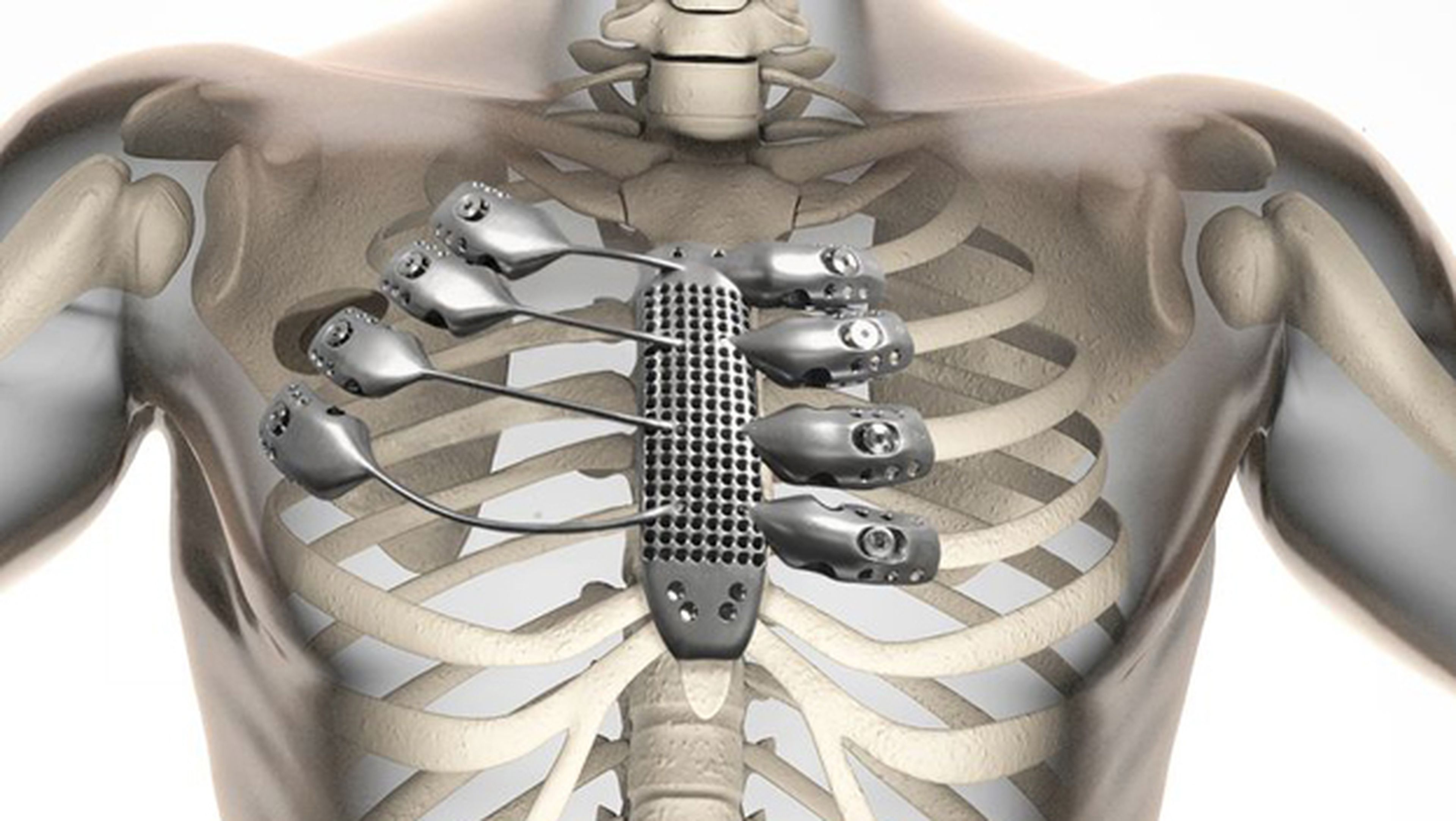 Implantan costillas impresas en 3D a un paciente español