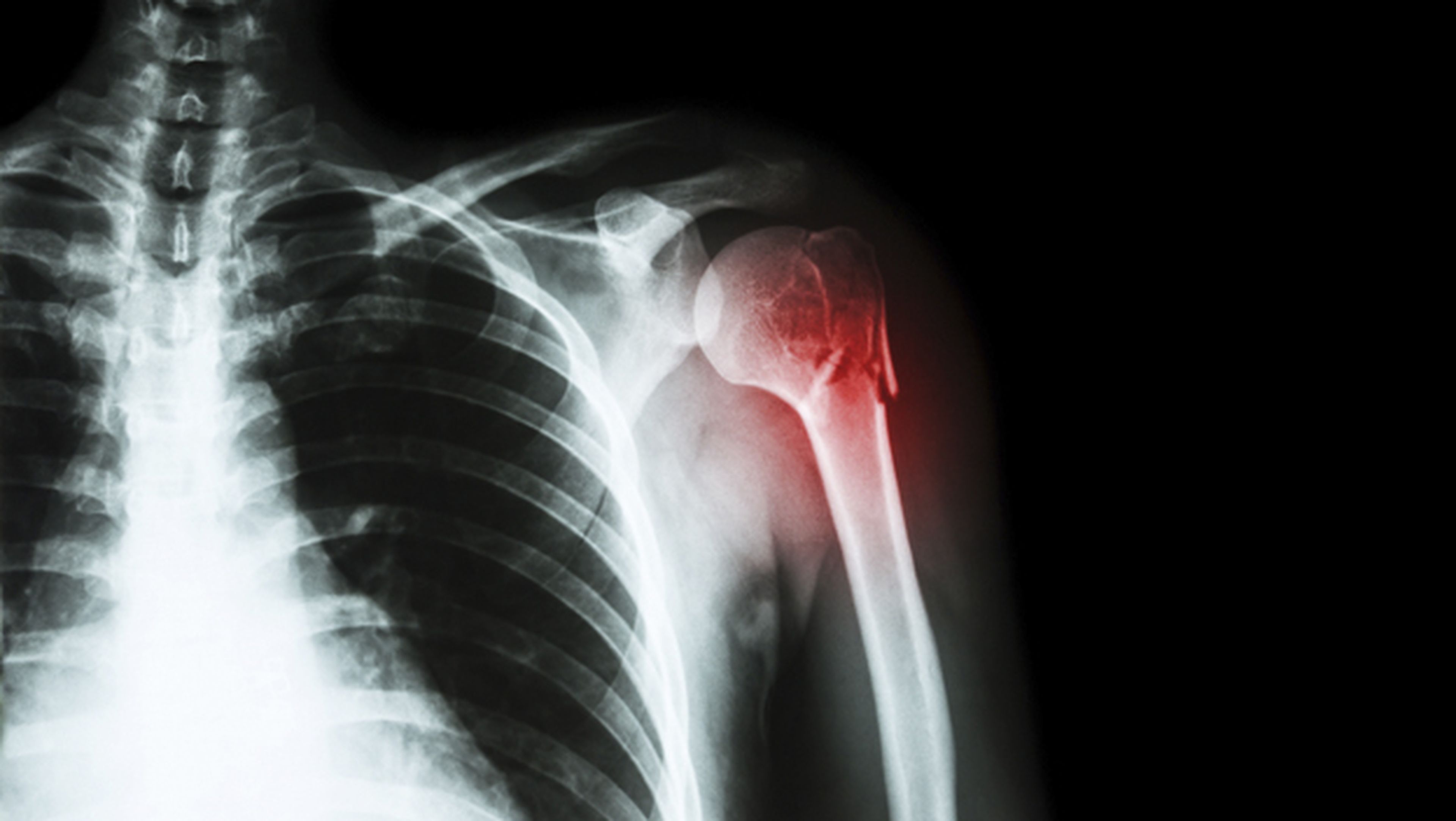 Implantes biodegradables ayudan a curar huesos rotos