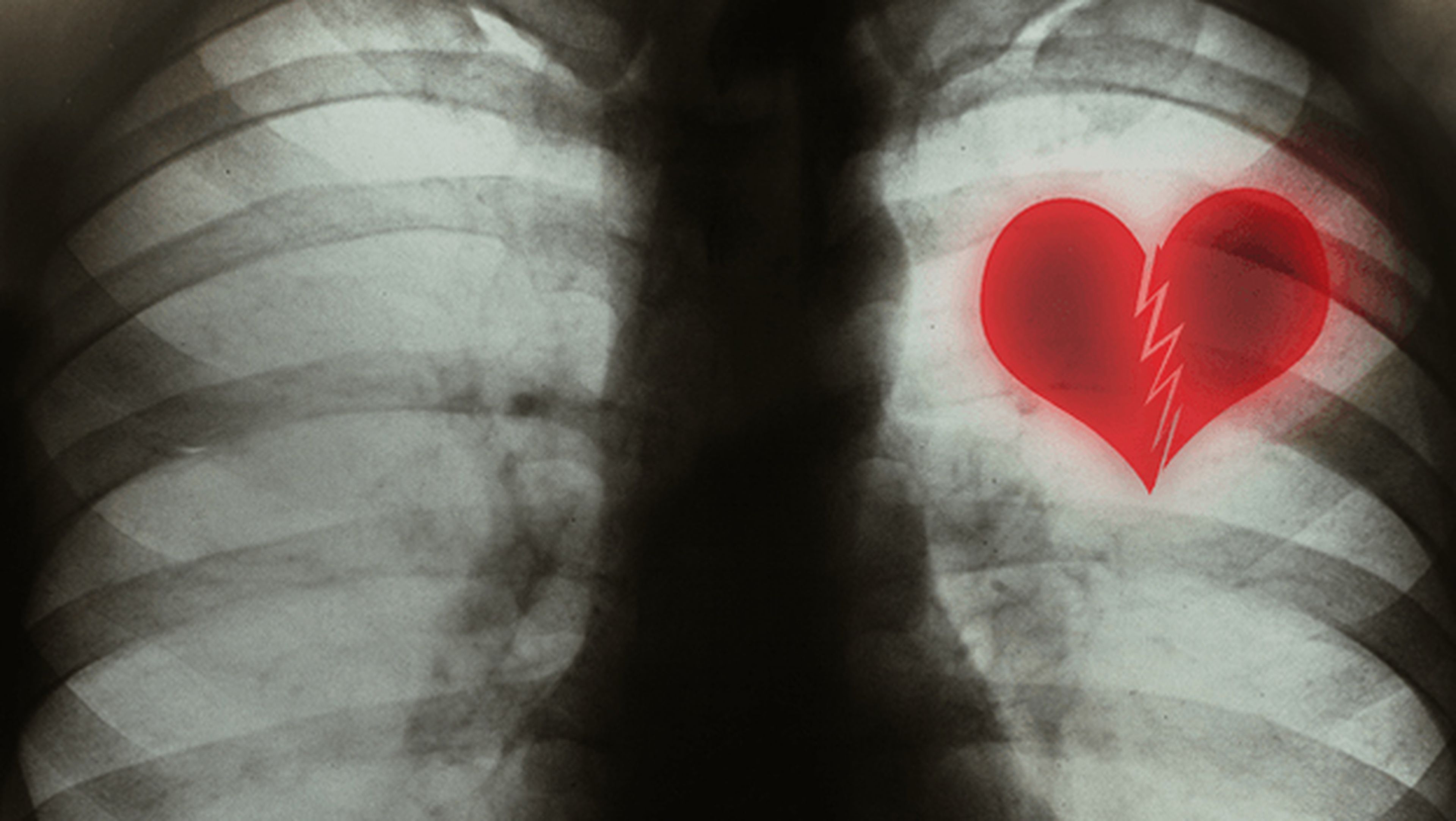 Sindrome del corazón roto o takotsubo cardiomiopatía