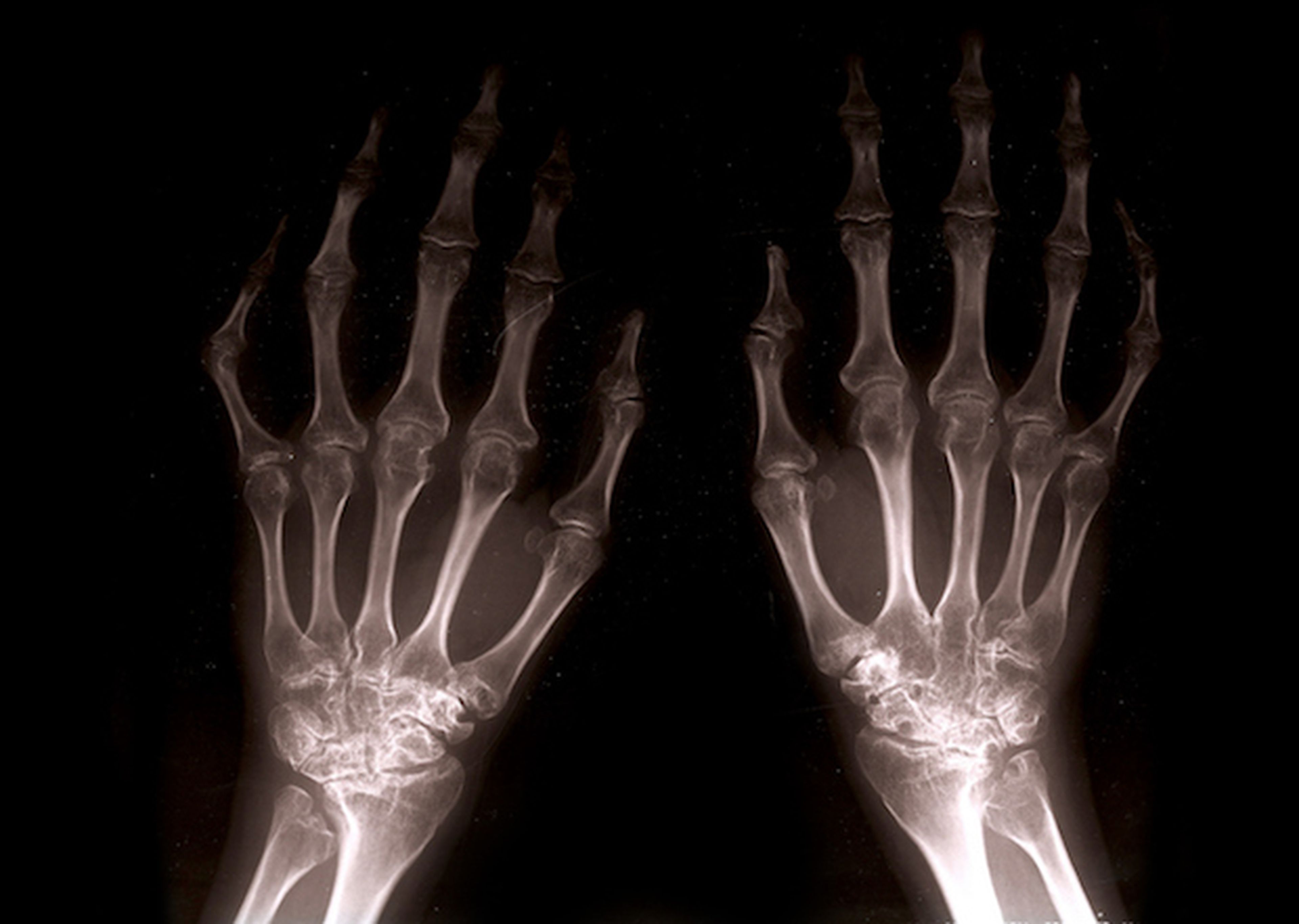 Radiografía de las manos