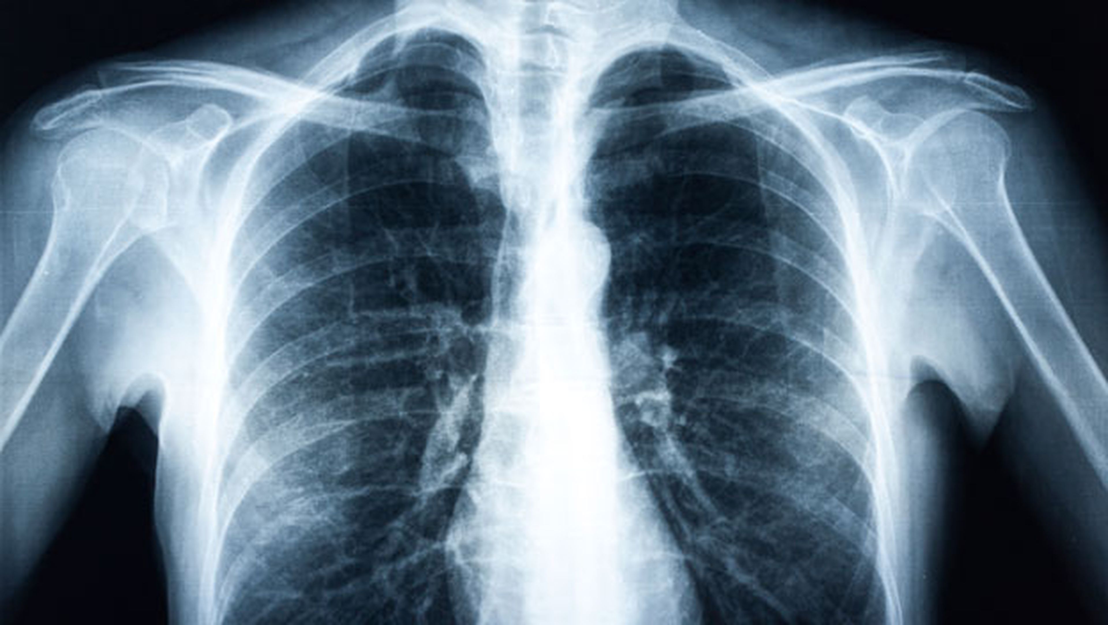 enfermedades pulmonares