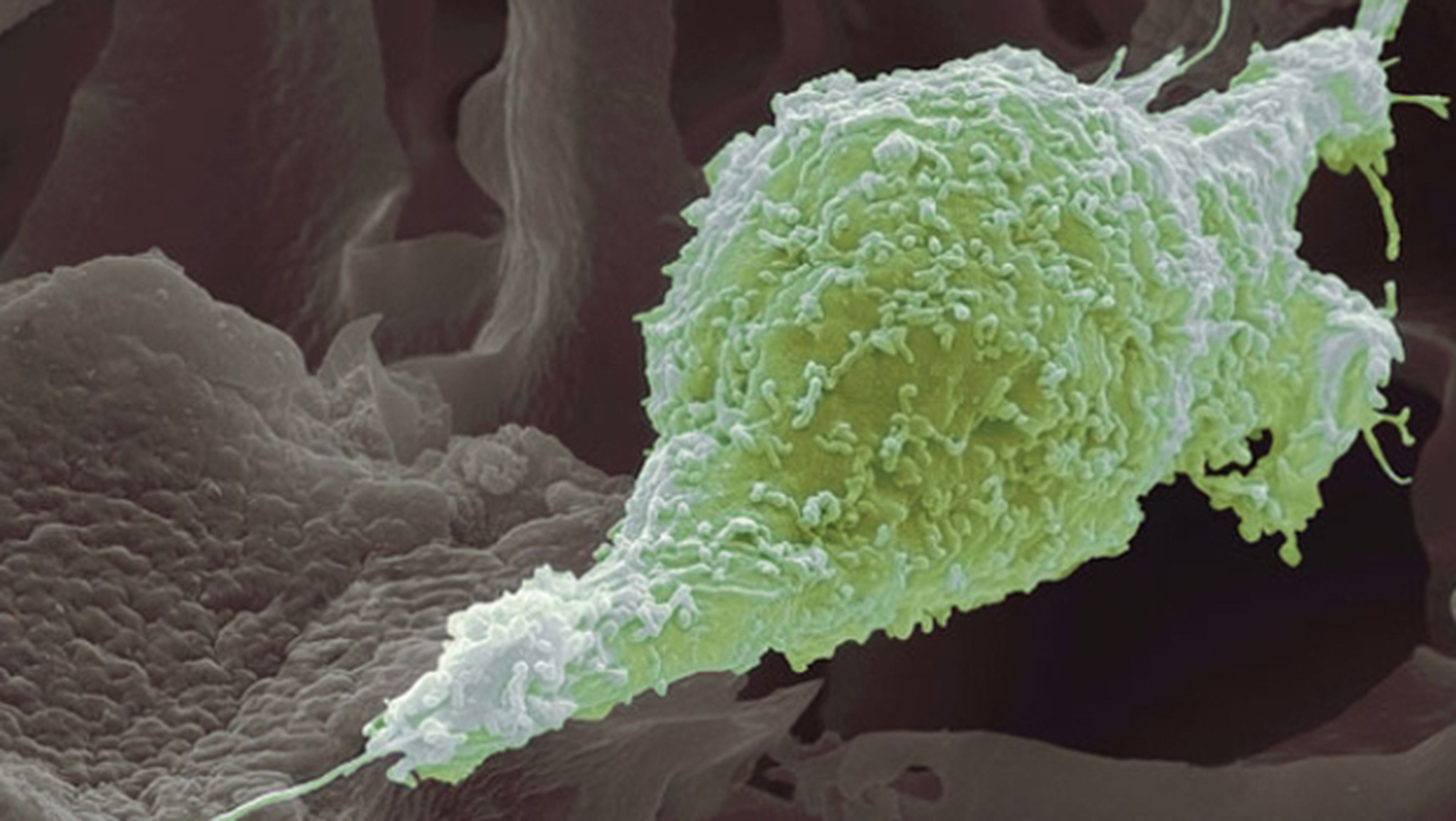 Imagen de un tumor y de las células cancerosas