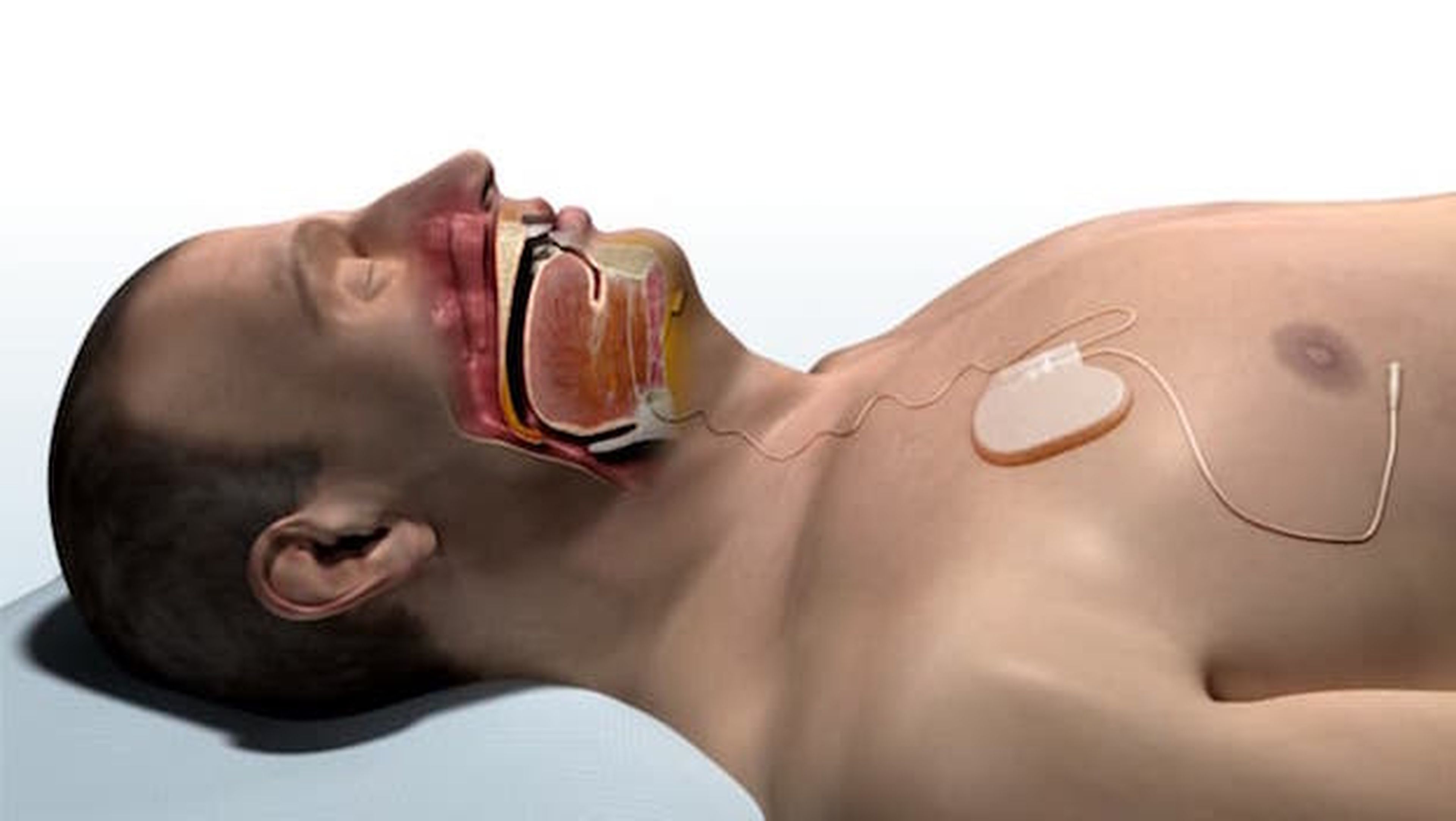 Nuevo implante ayuda a pacientes con apnea