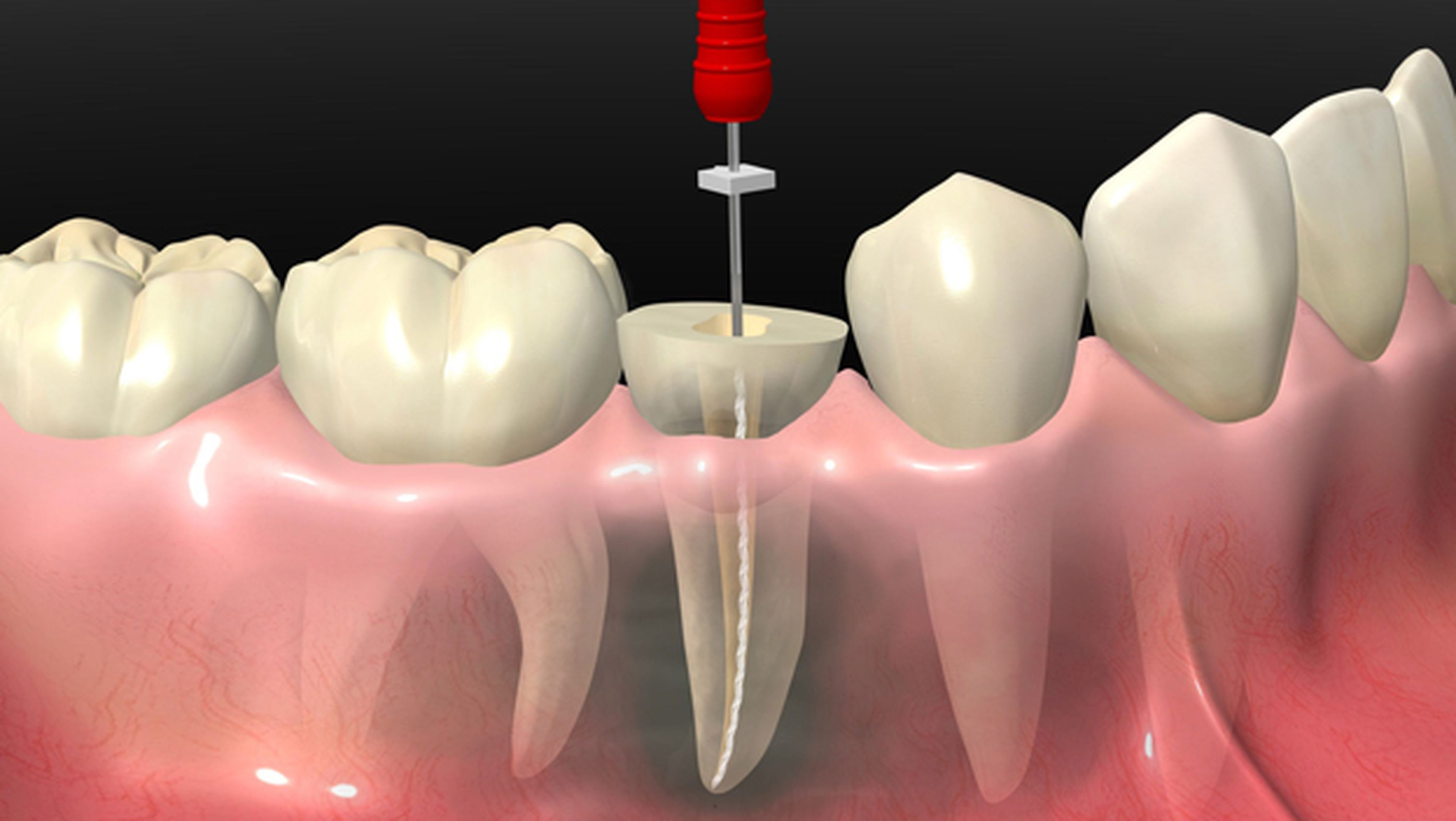Llega la alternativa a la endodoncia: regenerar dientes