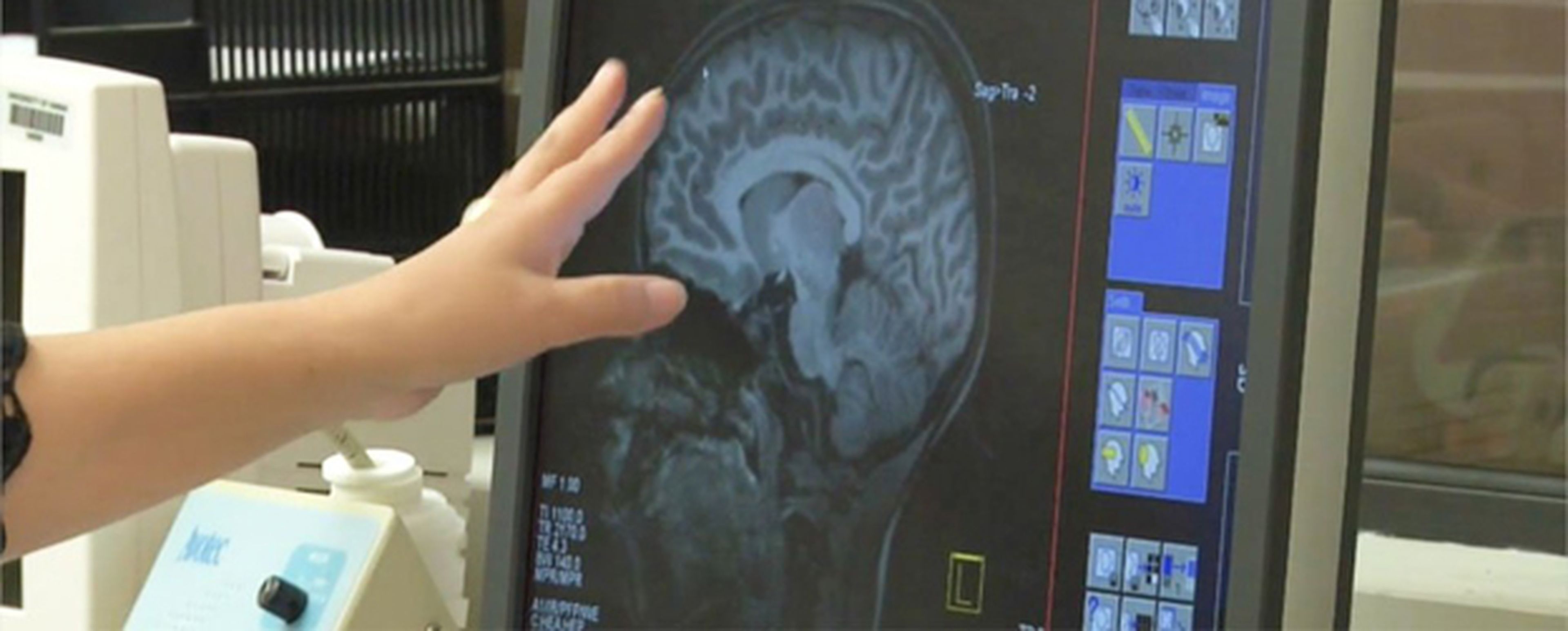 Un estudio descubre síntomas del Alzheimer en la infancia
