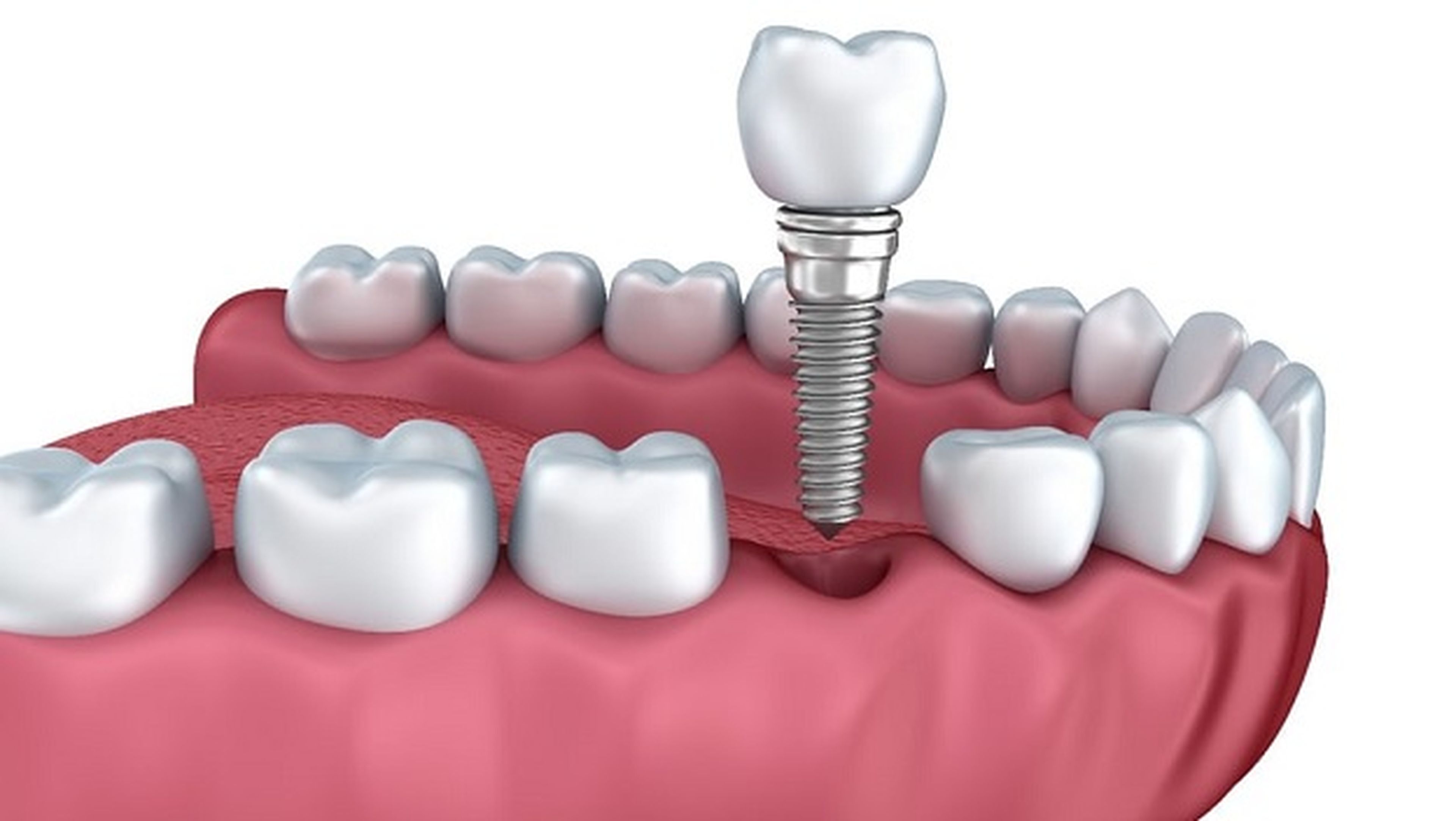 Nuevo revestimiento de implantes dentales combate infecciones