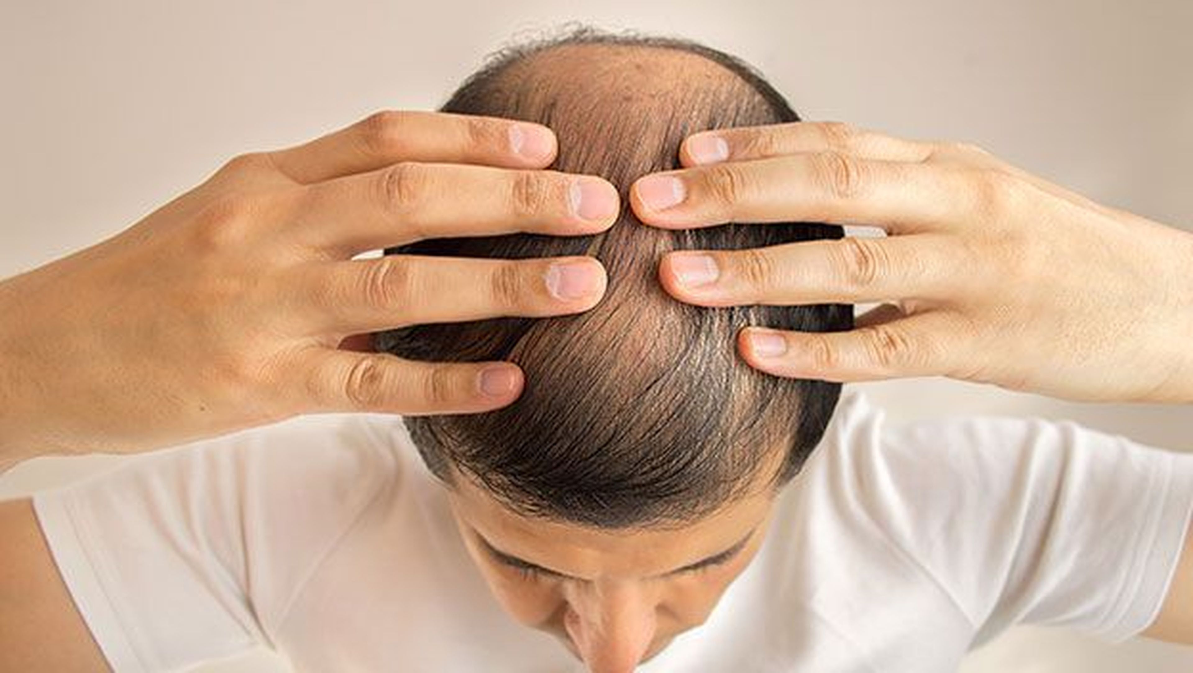 Nuevo tratamiento para la caída del cabello curar la calvicie | Computer Hoy