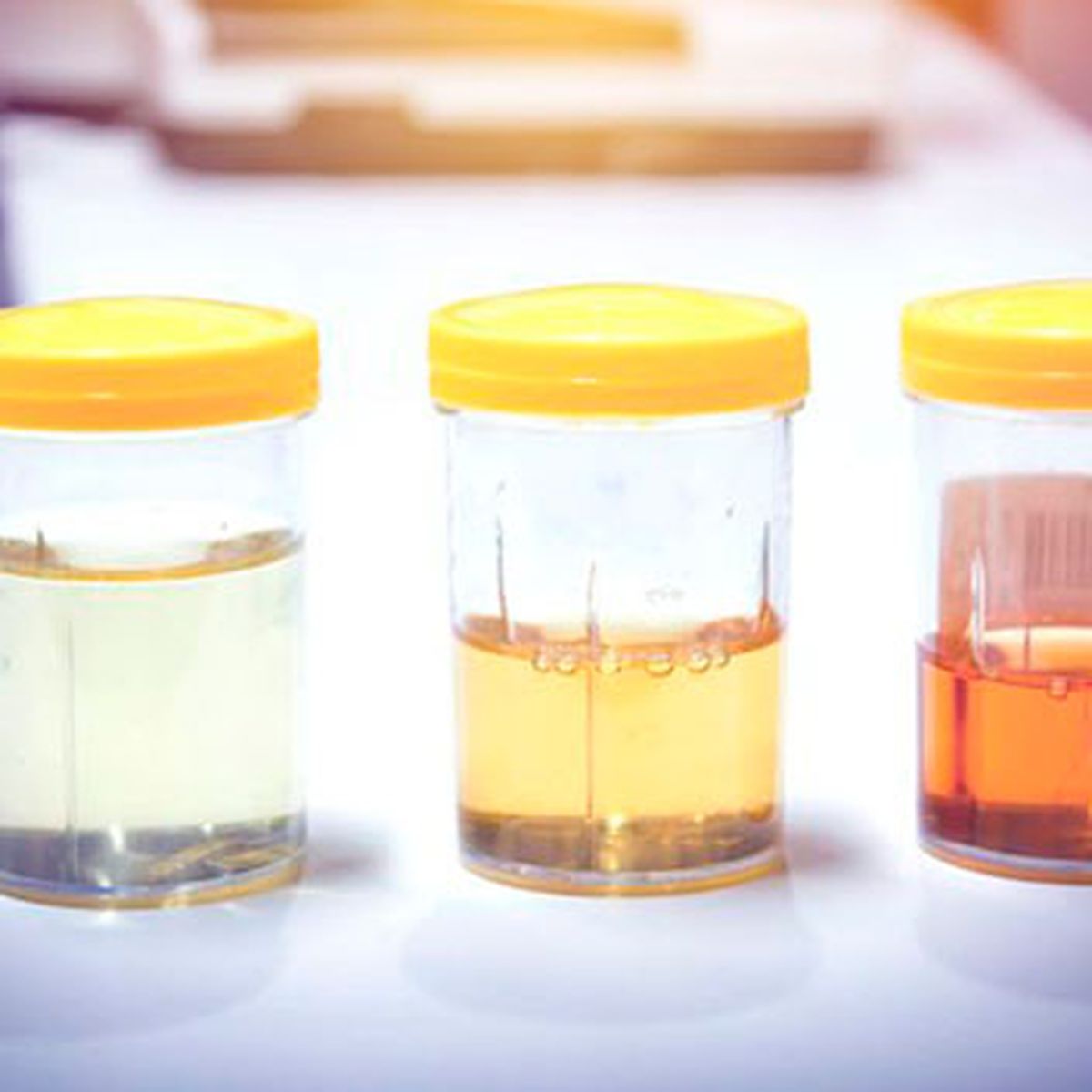 color anormal de la orina