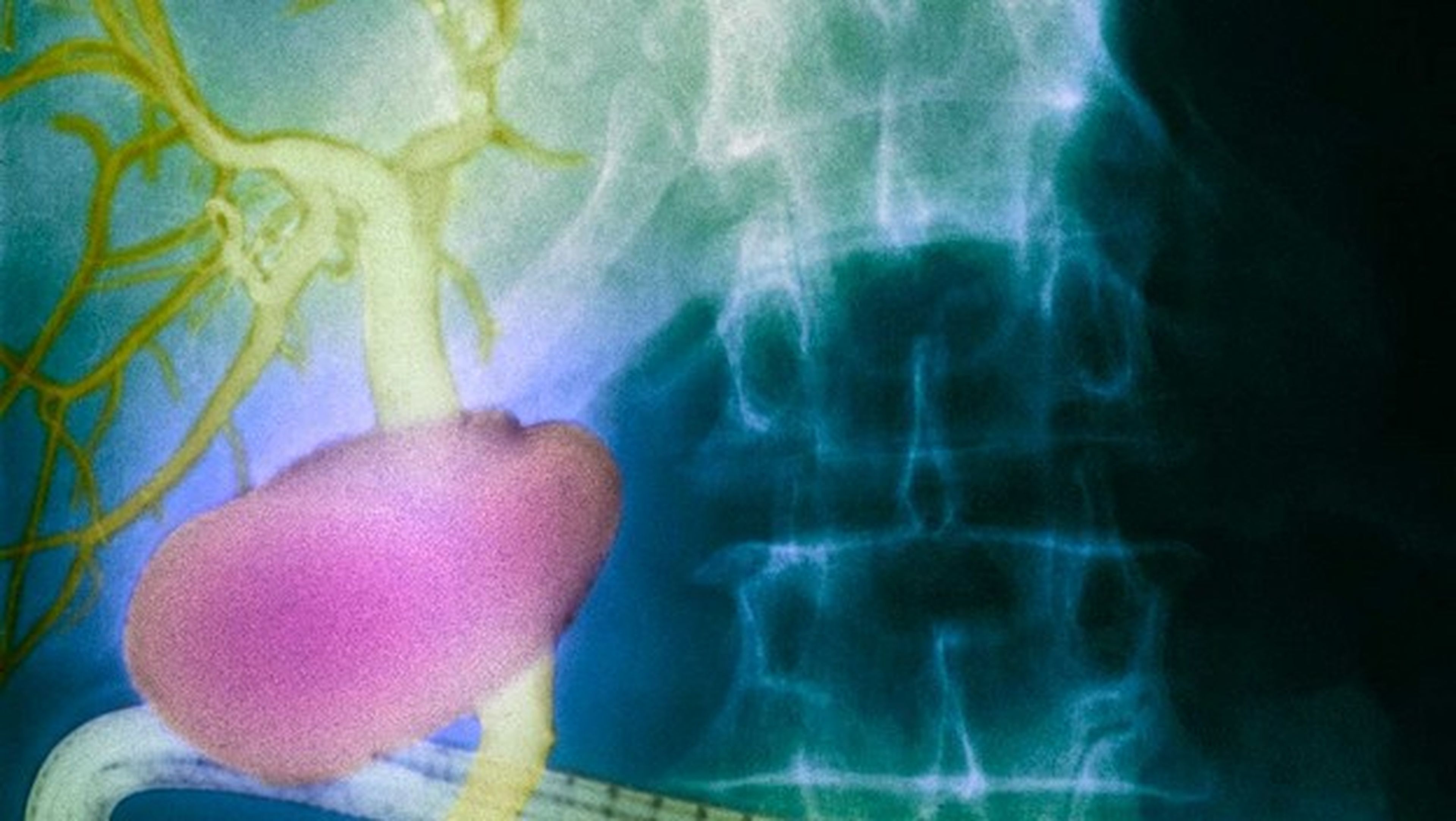 Descubren un nuevo órgano en el cuerpo humano asociado al cáncer