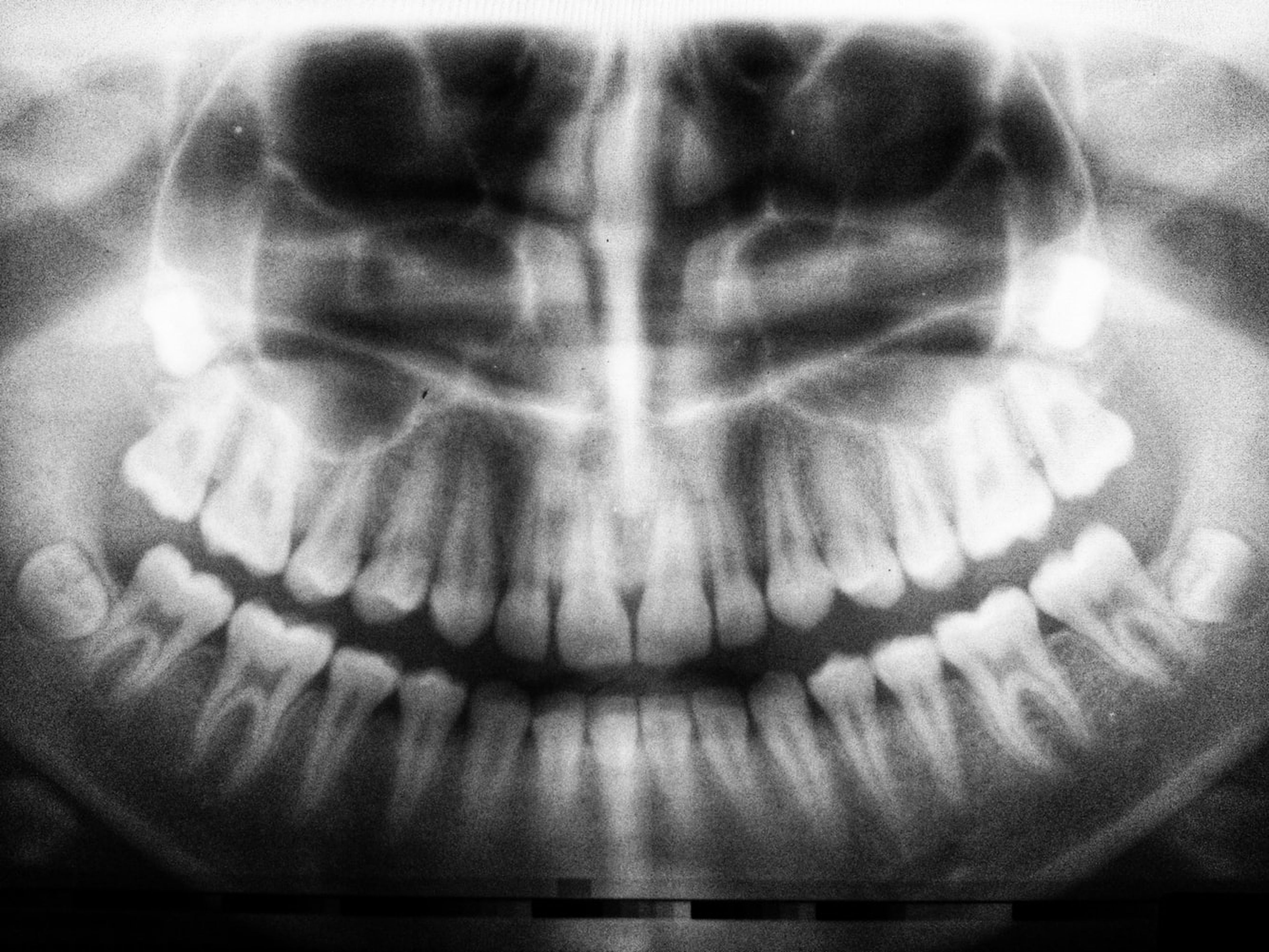 Radiografía de unos dientes