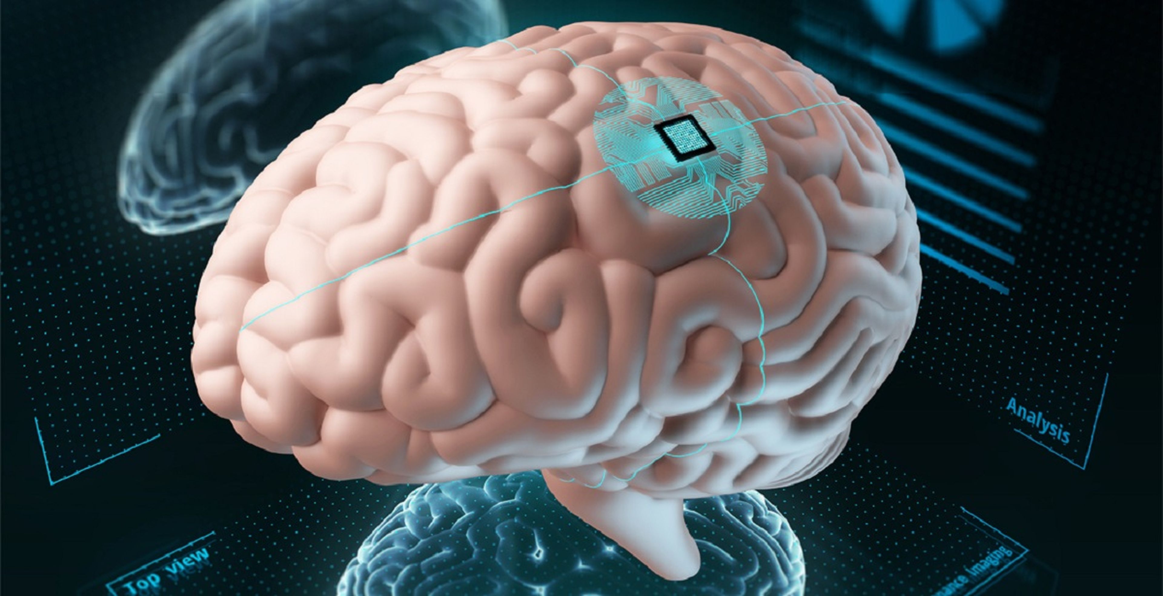 Un nuevo implante cerebral parece revertir los síntomas de la enfermedad de Parkinson