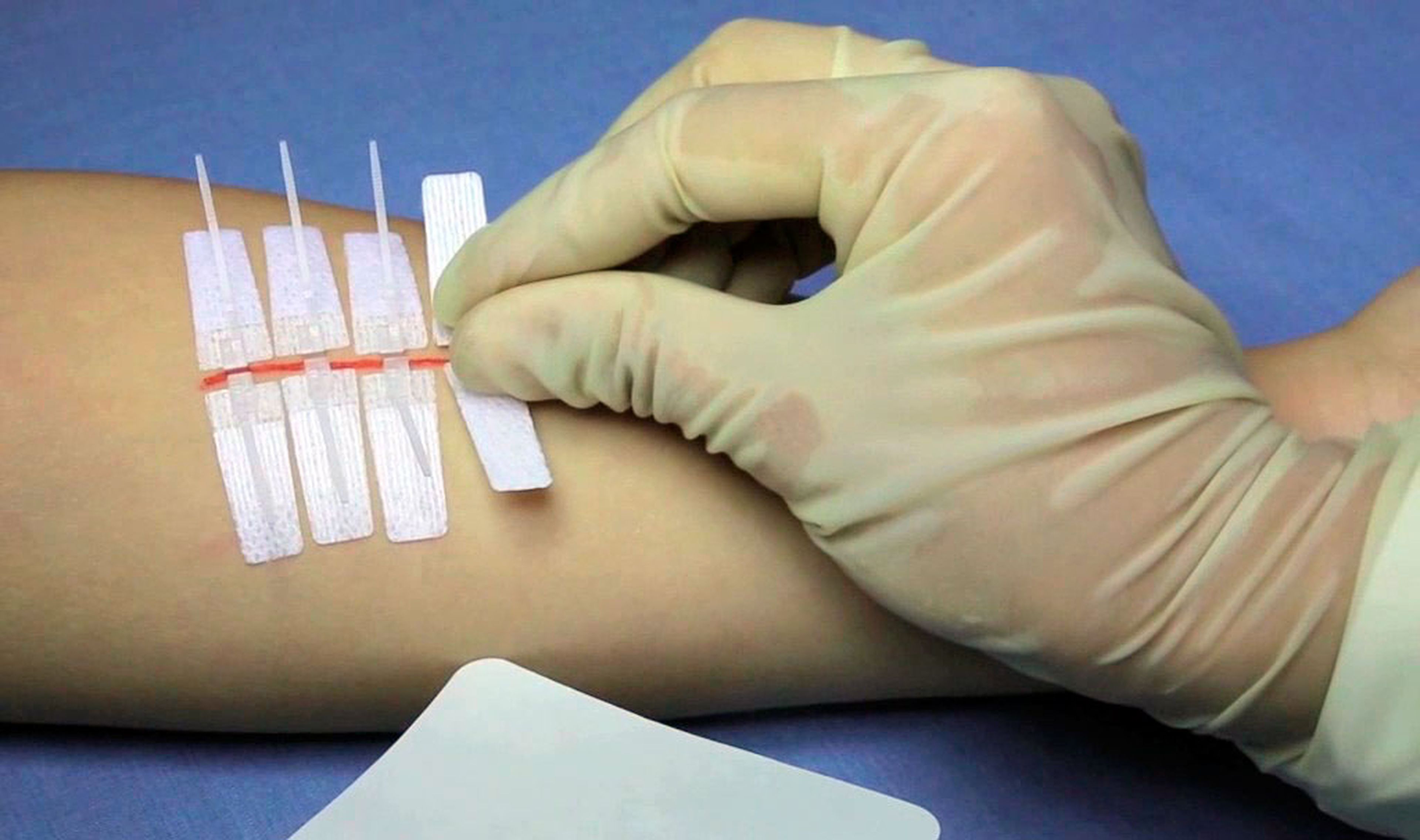 DermaClip, para cerrar heridas sin puntos de sutura