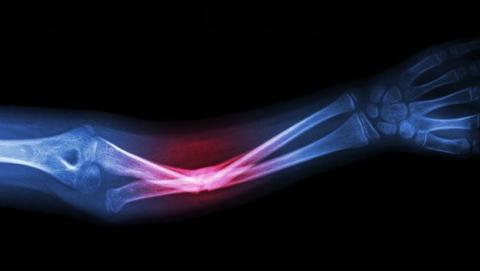 curar la osteoporosis curar la osteoporosis