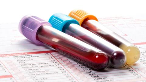 analisis sangre depresion analisis sangre depresion