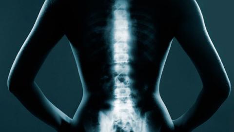 epidural epidural