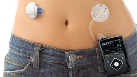 pancreas artificial pancreas artificial